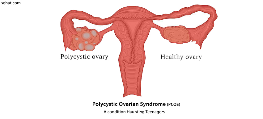 Polycystic Ovarian Syndrome- A condition Haunting Teenager's